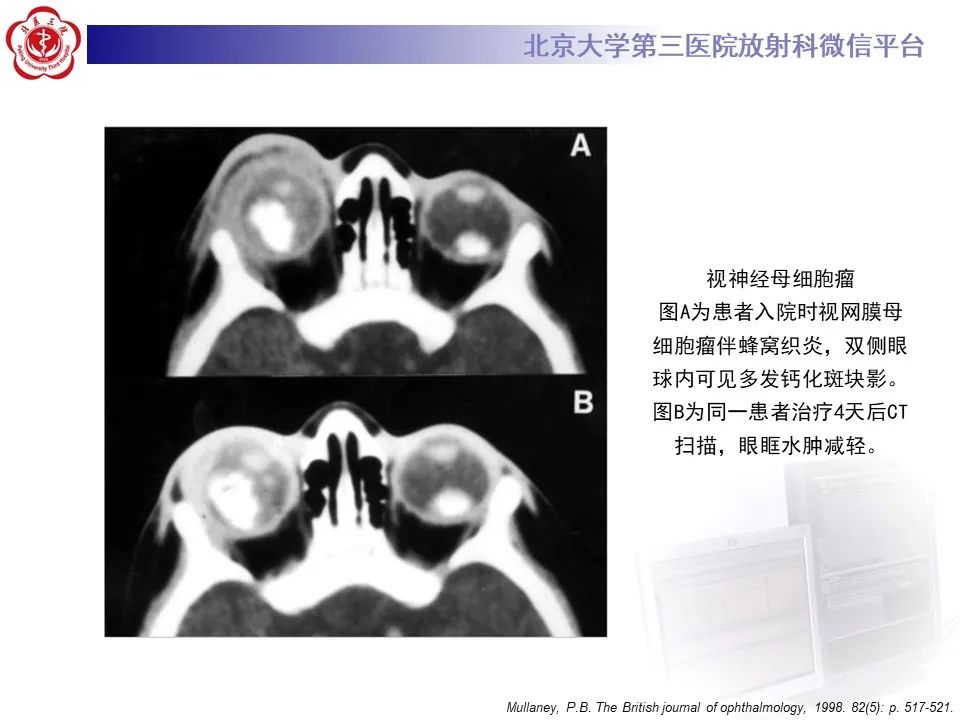 影像PPT - 【PPT】脉络膜黑色素瘤的影像-26