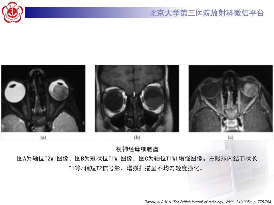 影像PPT - 【PPT】脉络膜黑色素瘤的影像-27