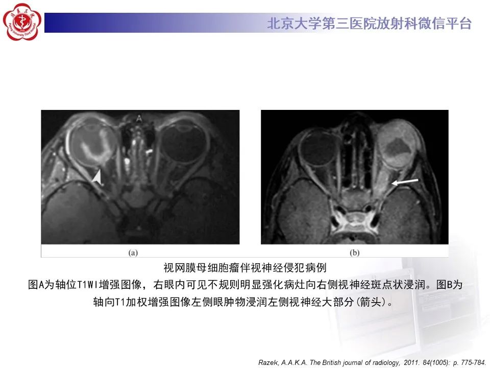 影像PPT - 【PPT】脉络膜黑色素瘤的影像-28