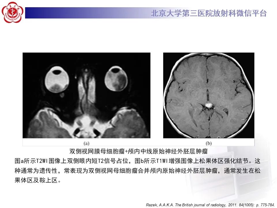 影像PPT - 【PPT】脉络膜黑色素瘤的影像-29