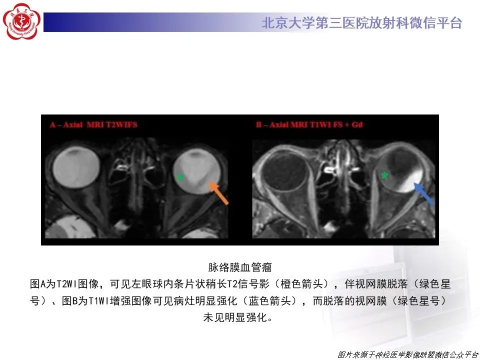 影像PPT - 【PPT】脉络膜黑色素瘤的影像-31