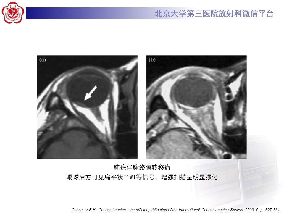 影像PPT - 【PPT】脉络膜黑色素瘤的影像-33