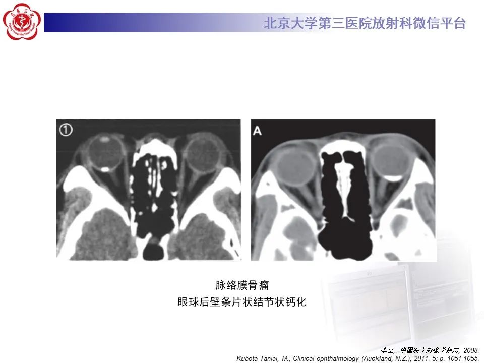 影像PPT - 【PPT】脉络膜黑色素瘤的影像-35