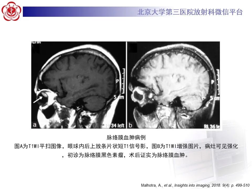 影像PPT - 【PPT】脉络膜黑色素瘤的影像-37
