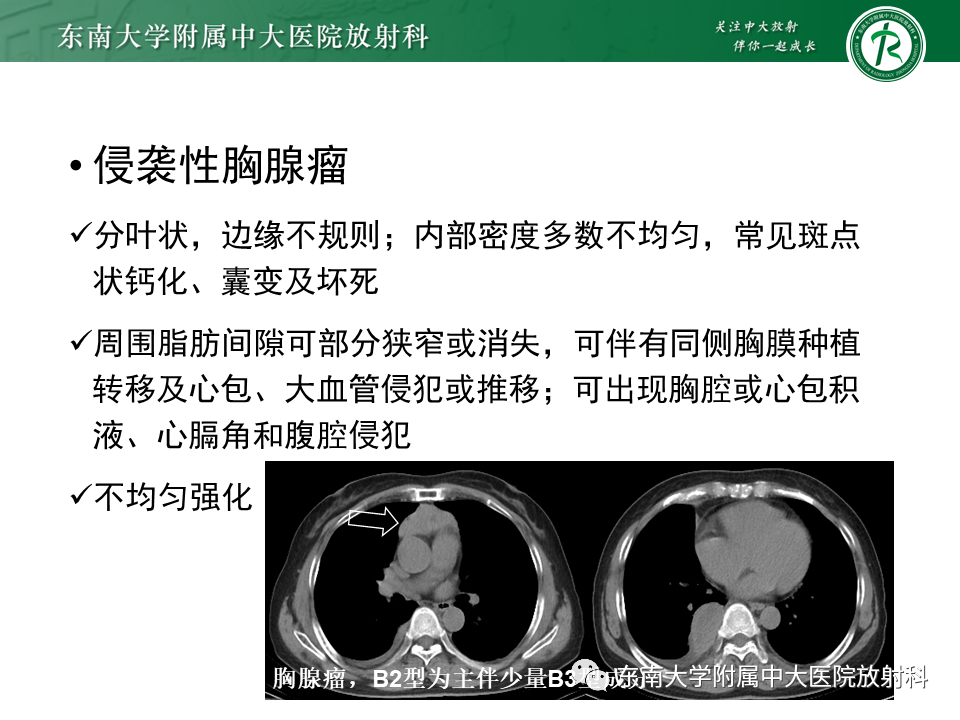 影像PPT - 【病例】胸腺瘤1例CT影像诊断-9