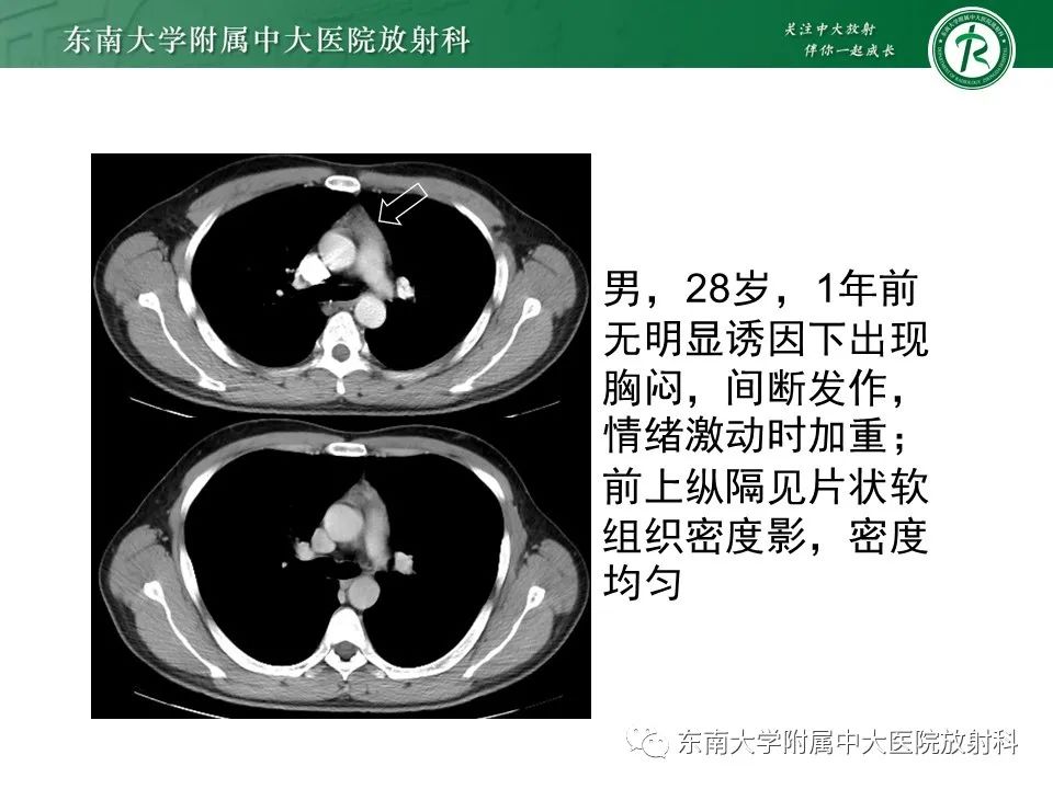 影像PPT - 【病例】胸腺瘤1例CT影像诊断-12
