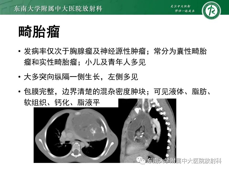 影像PPT - 【病例】胸腺瘤1例CT影像诊断-14