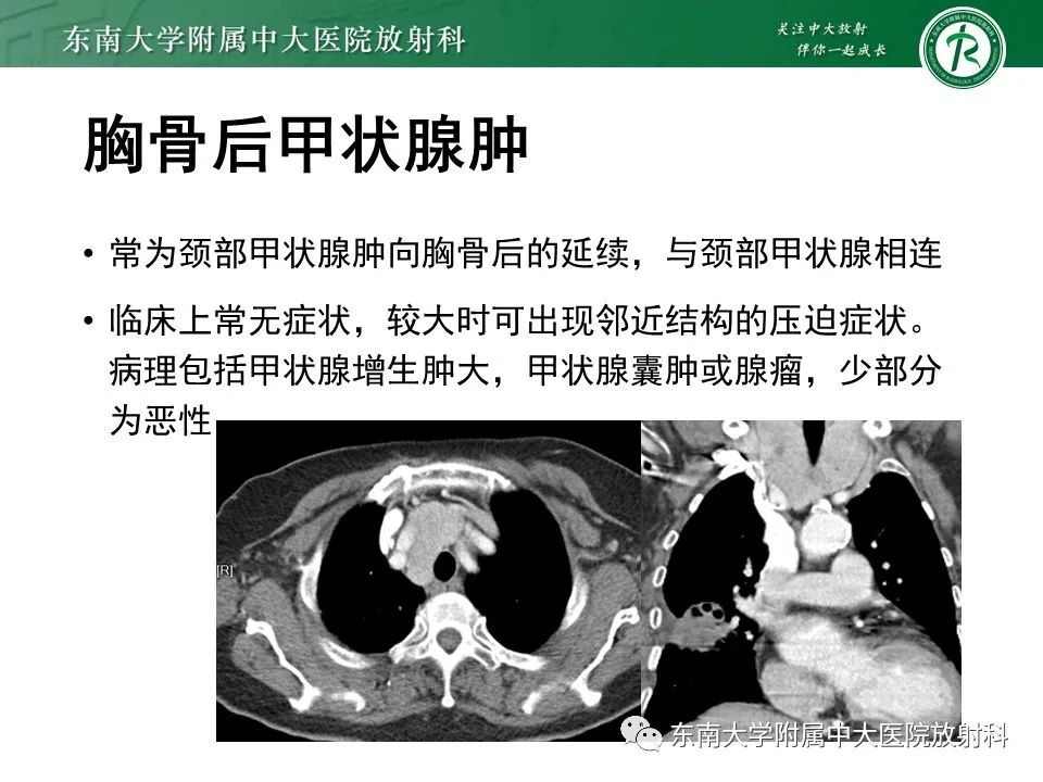 影像PPT - 【病例】胸腺瘤1例CT影像诊断-15