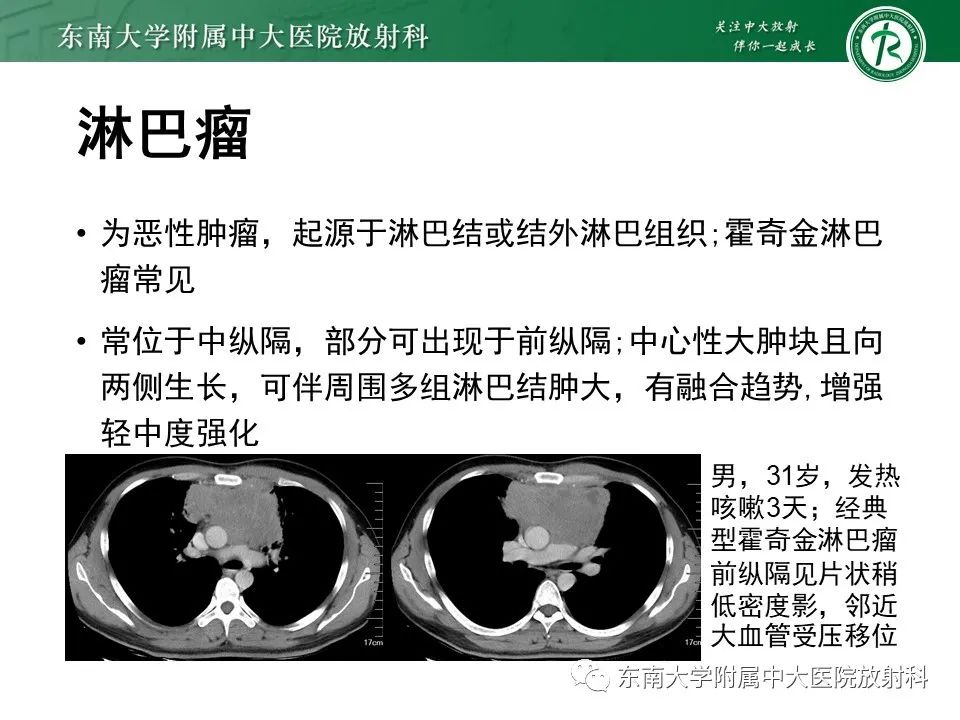 影像PPT - 【病例】胸腺瘤1例CT影像诊断-16