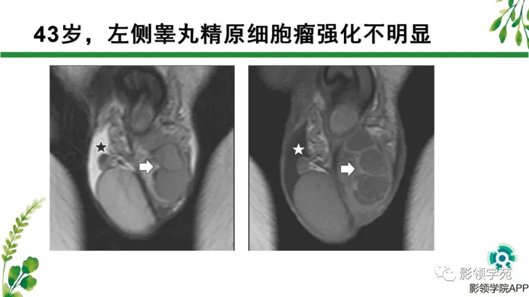 影像PPT - 【PPT】睾丸肿瘤MRI诊断-11
