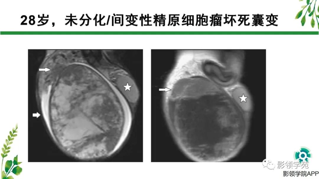 影像PPT - 【PPT】睾丸肿瘤MRI诊断-12