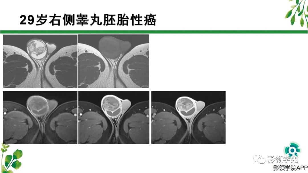 影像PPT - 【PPT】睾丸肿瘤MRI诊断-15