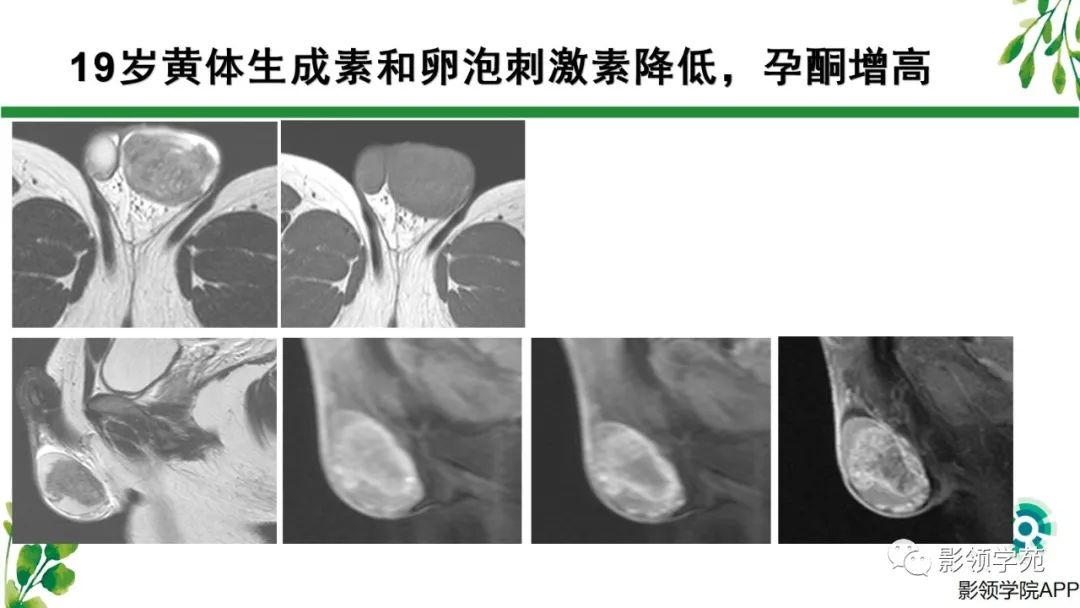 影像PPT - 【PPT】睾丸肿瘤MRI诊断-17