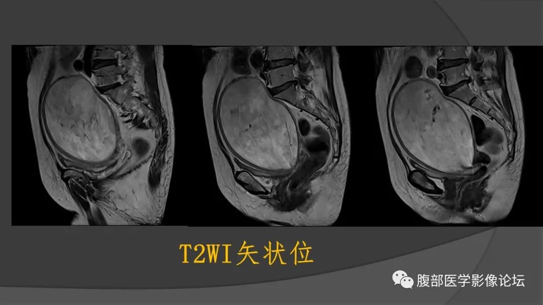 影像PPT - 【病例】子宫内膜癌肉瘤1例MR影像-5
