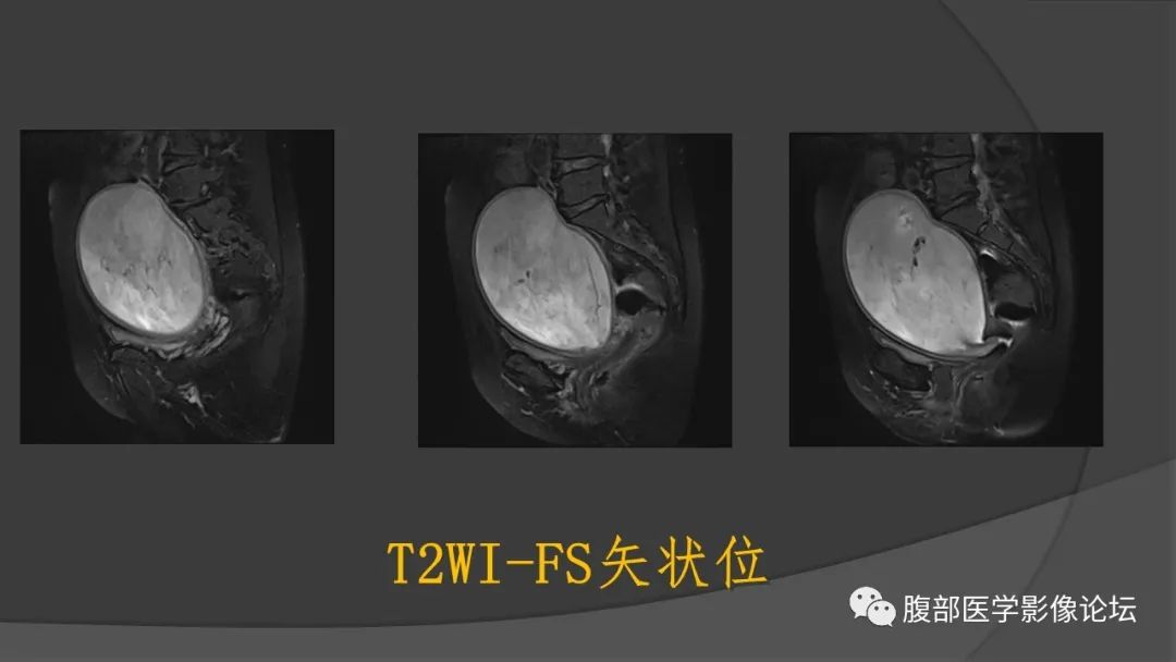 影像PPT - 【病例】子宫内膜癌肉瘤1例MR影像-6