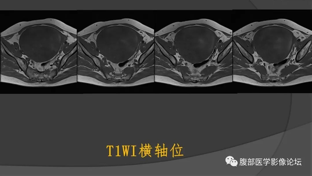 影像PPT - 【病例】子宫内膜癌肉瘤1例MR影像-7