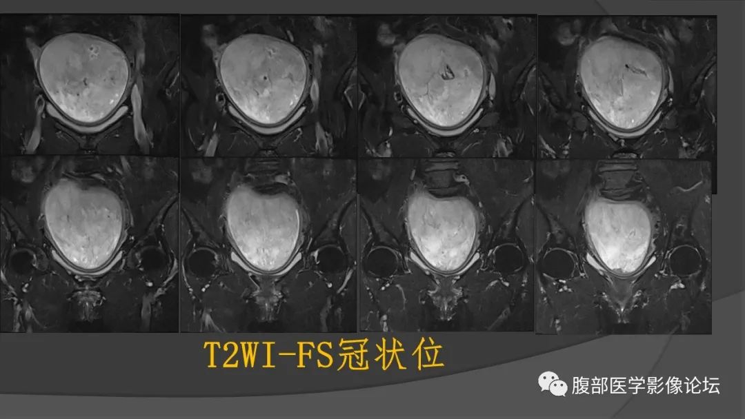 影像PPT - 【病例】子宫内膜癌肉瘤1例MR影像-8
