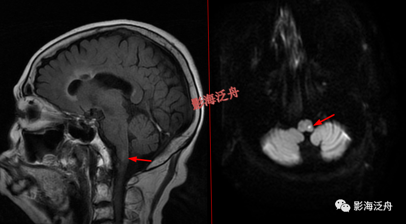 影像PPT - 颅脑MR中易漏诊点全面总结-4 影像PPT - 颅脑MR中易漏诊点全面总结-4
