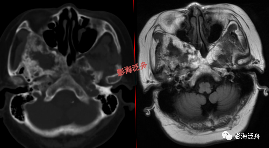 影像PPT - 颅脑MR中易漏诊点全面总结-13 影像PPT - 颅脑MR中易漏诊点全面总结-13