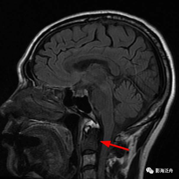 影像PPT - 颅脑MR中易漏诊点全面总结-15 影像PPT - 颅脑MR中易漏诊点全面总结-15