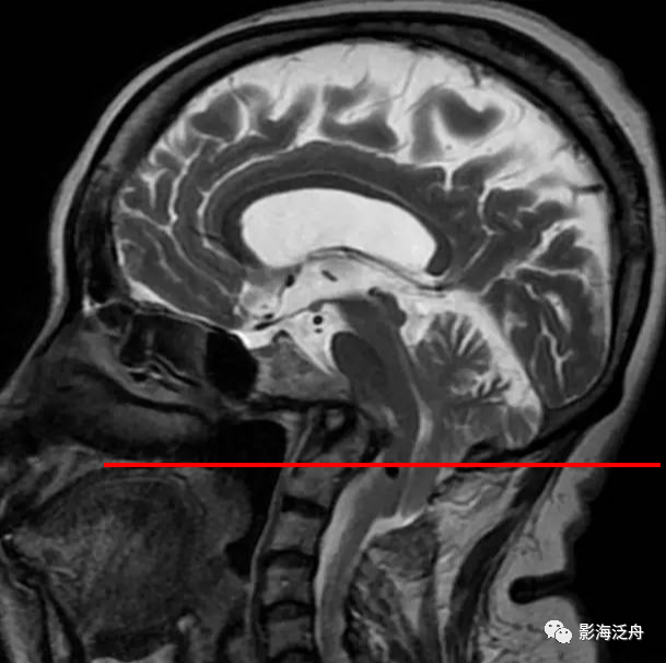 影像PPT - 颅脑MR中易漏诊点全面总结-16 影像PPT - 颅脑MR中易漏诊点全面总结-16