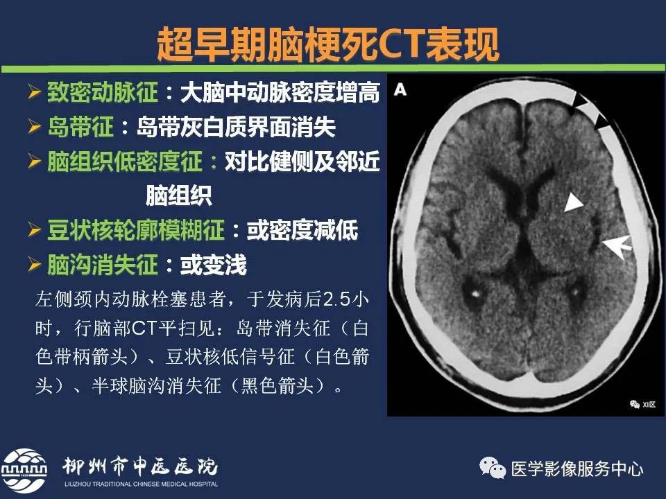 影像PPT - 【PPT】超早期脑梗死CT征象-5