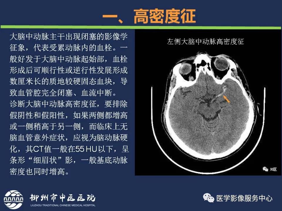 影像PPT - 【PPT】超早期脑梗死CT征象-6