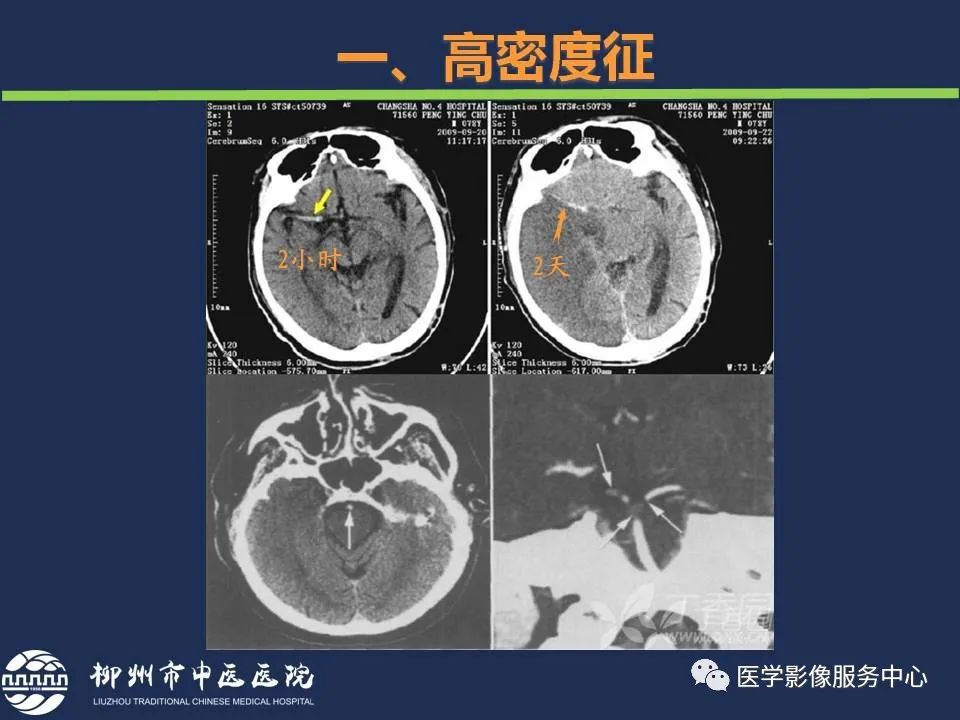 影像PPT - 【PPT】超早期脑梗死CT征象-7