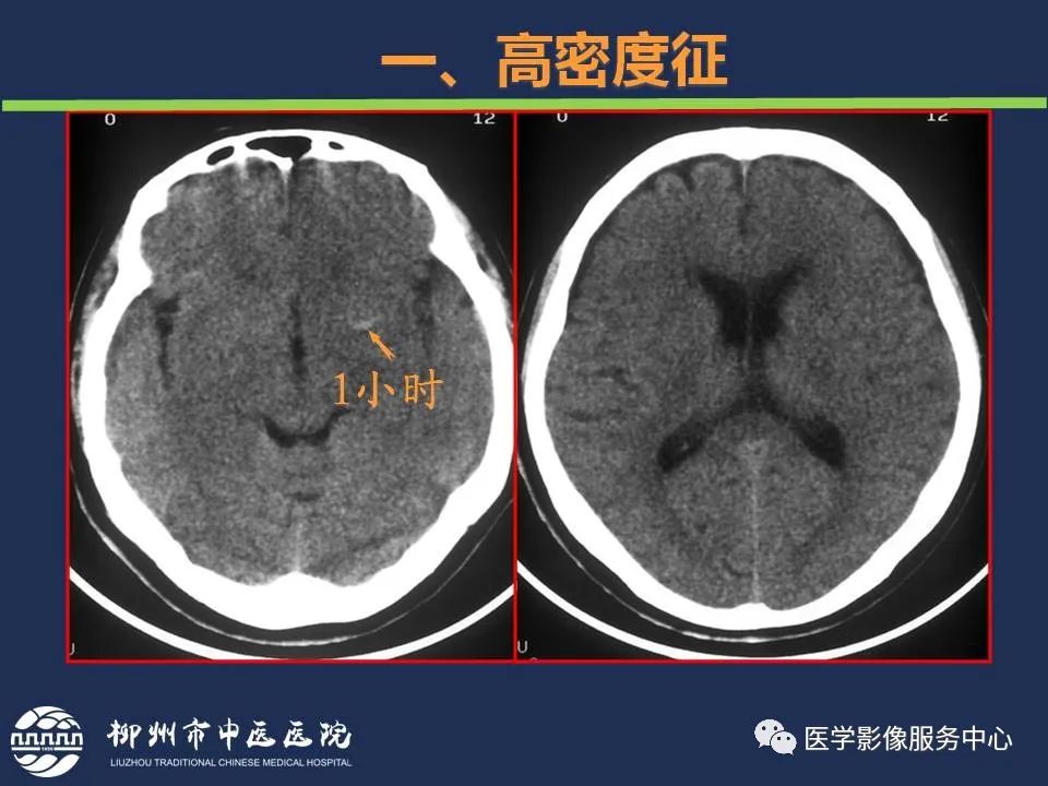 影像PPT - 【PPT】超早期脑梗死CT征象-8