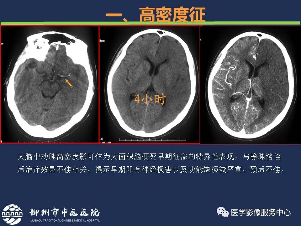 影像PPT - 【PPT】超早期脑梗死CT征象-9