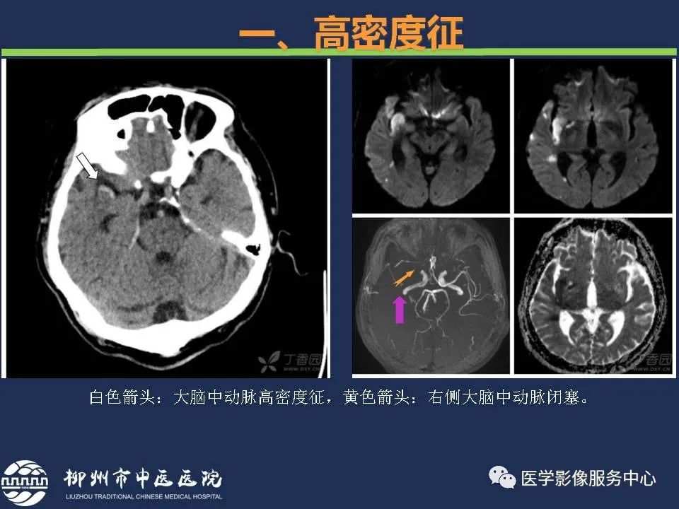 影像PPT - 【PPT】超早期脑梗死CT征象-10