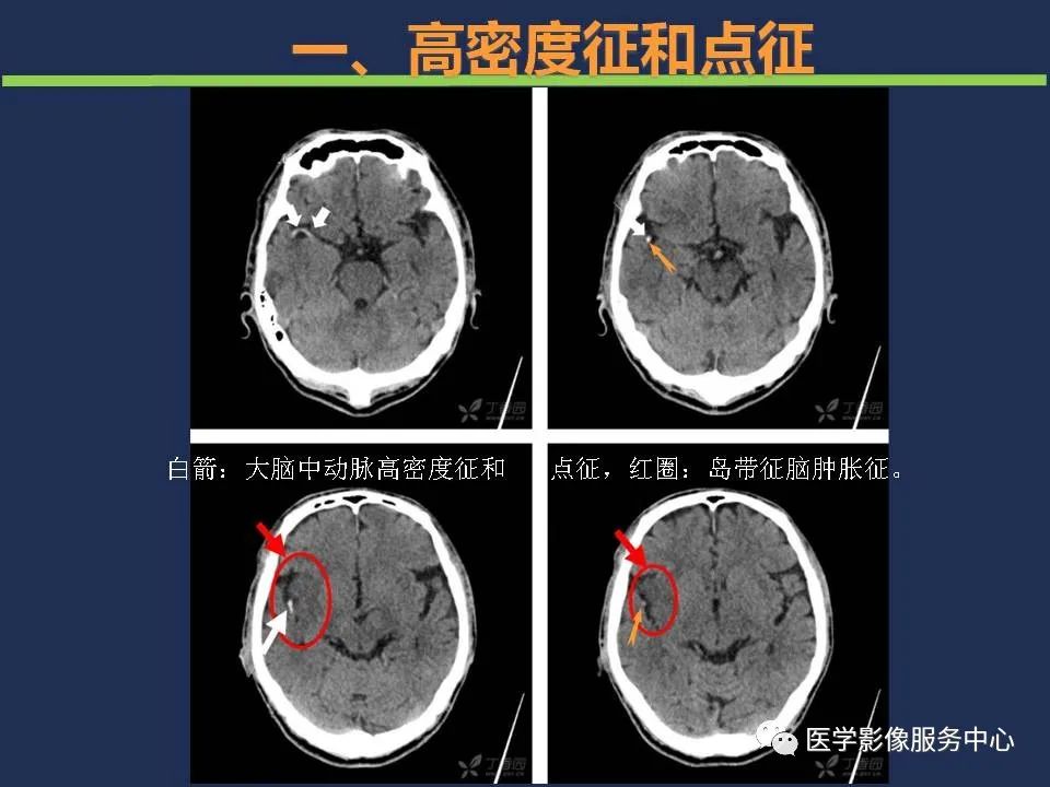 影像PPT - 【PPT】超早期脑梗死CT征象-11