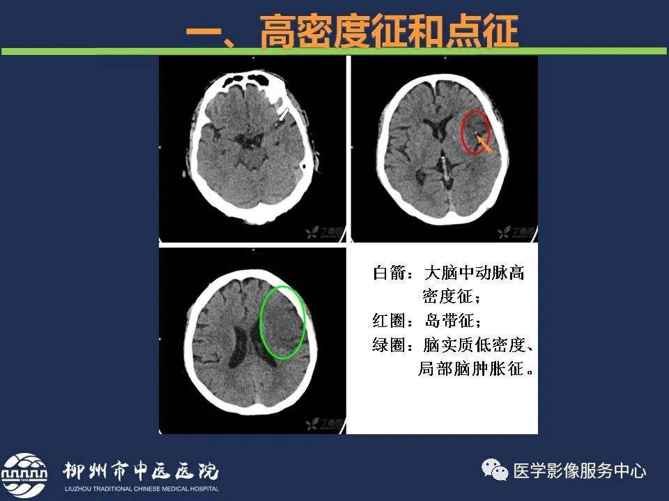 影像PPT - 【PPT】超早期脑梗死CT征象-12