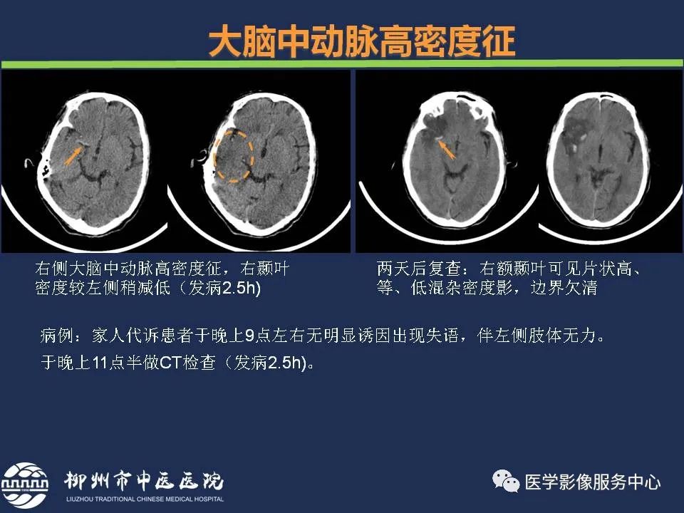 影像PPT - 【PPT】超早期脑梗死CT征象-13