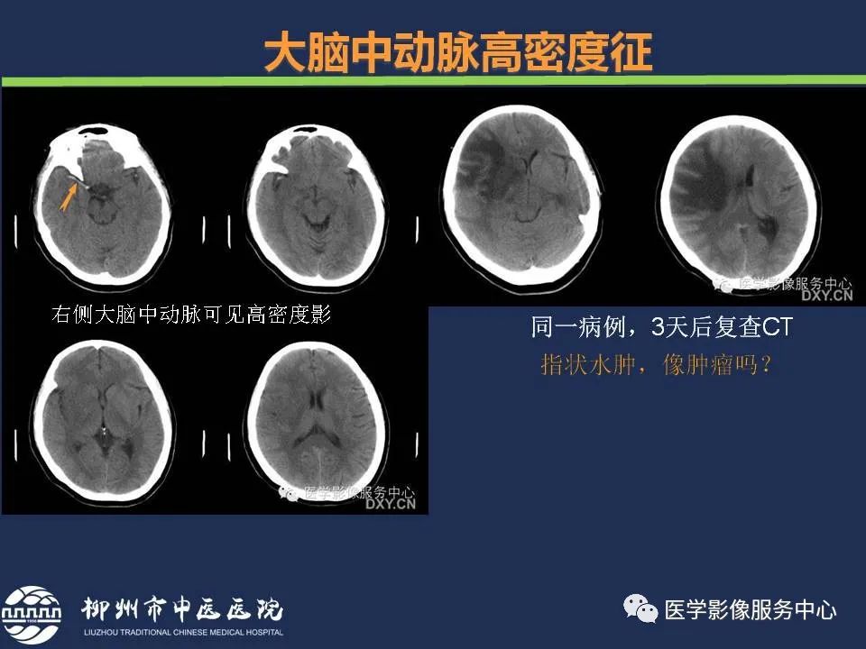 影像PPT - 【PPT】超早期脑梗死CT征象-14