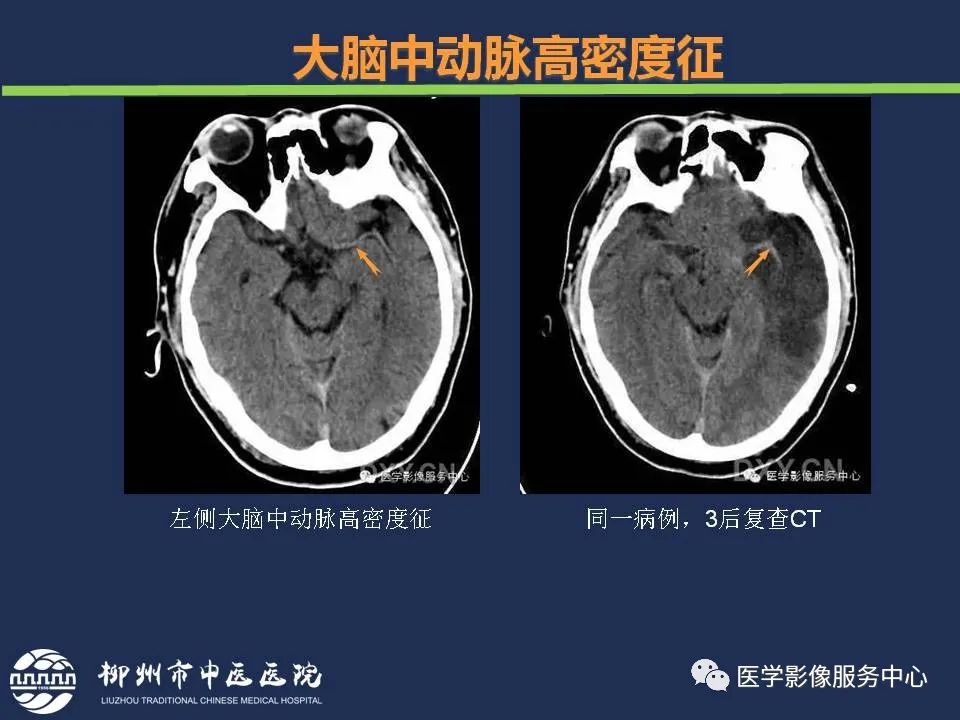 影像PPT - 【PPT】超早期脑梗死CT征象-15