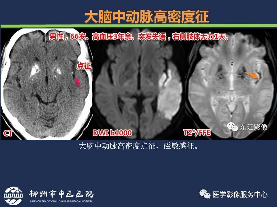 影像PPT - 【PPT】超早期脑梗死CT征象-16