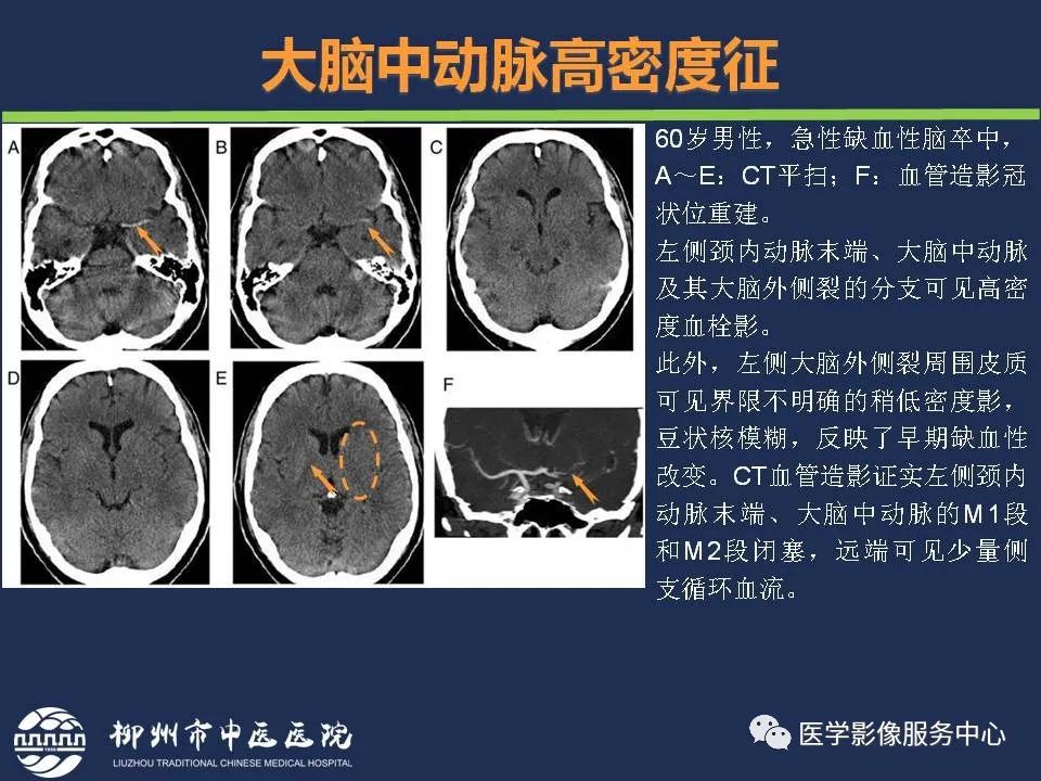 影像PPT - 【PPT】超早期脑梗死CT征象-17