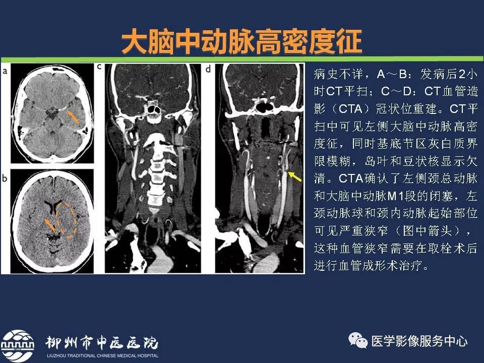 影像PPT - 【PPT】超早期脑梗死CT征象-18