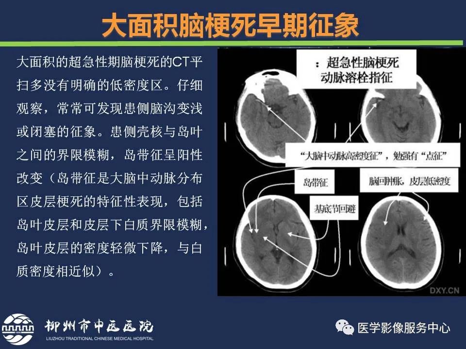 影像PPT - 【PPT】超早期脑梗死CT征象-19