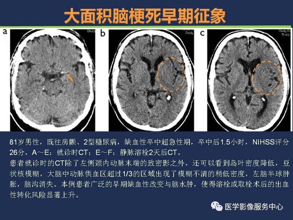 影像PPT - 【PPT】超早期脑梗死CT征象-20