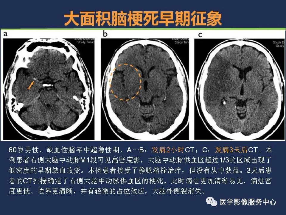 影像PPT - 【PPT】超早期脑梗死CT征象-21