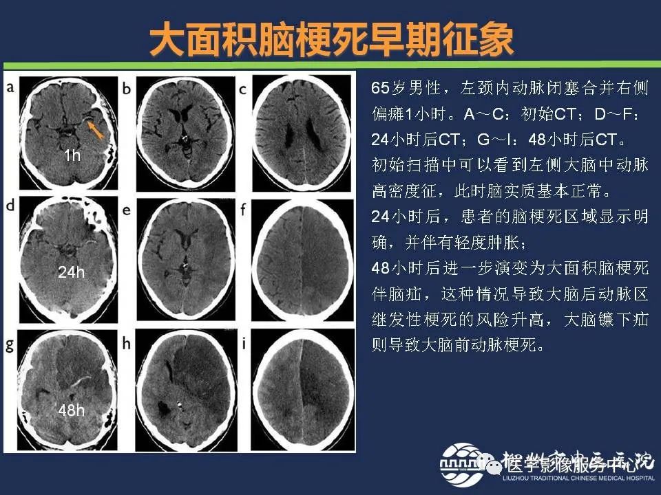 影像PPT - 【PPT】超早期脑梗死CT征象-22