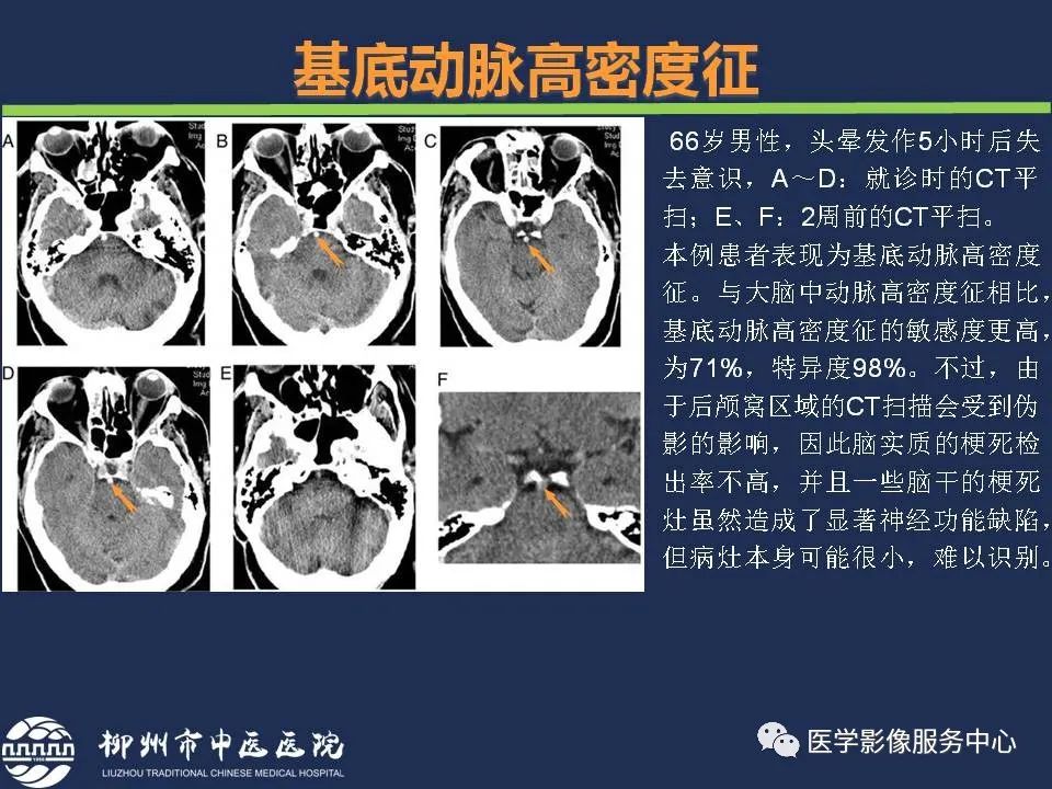 影像PPT - 【PPT】超早期脑梗死CT征象-23