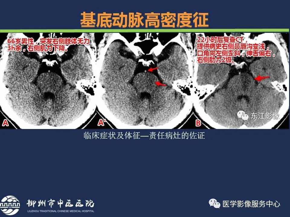 影像PPT - 【PPT】超早期脑梗死CT征象-24