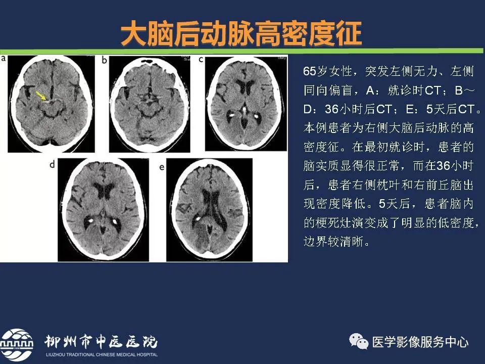 影像PPT - 【PPT】超早期脑梗死CT征象-25