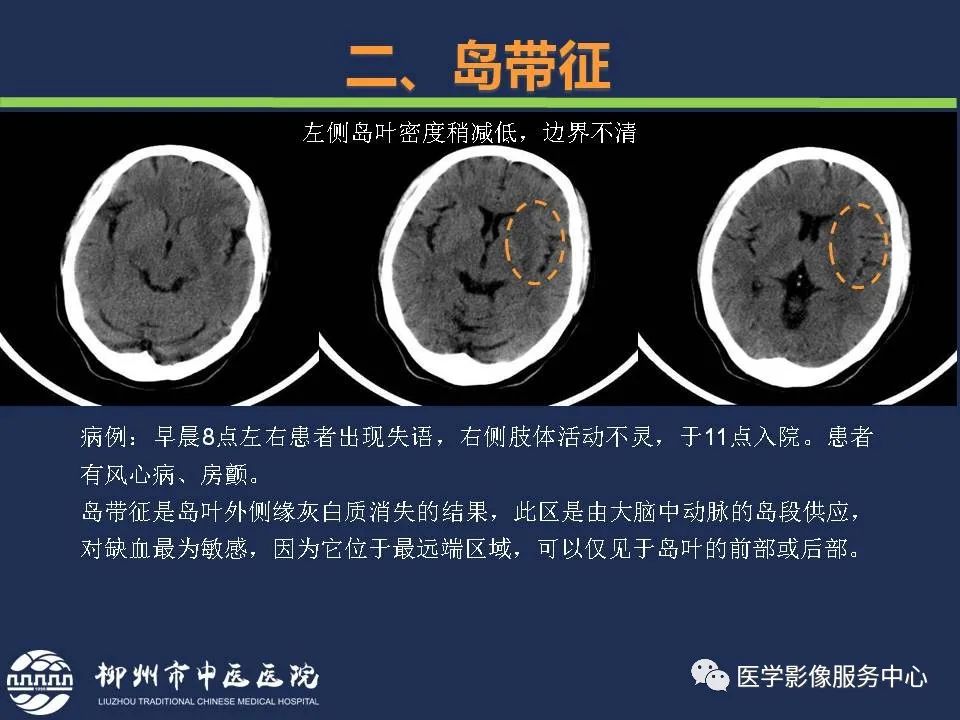 影像PPT - 【PPT】超早期脑梗死CT征象-26