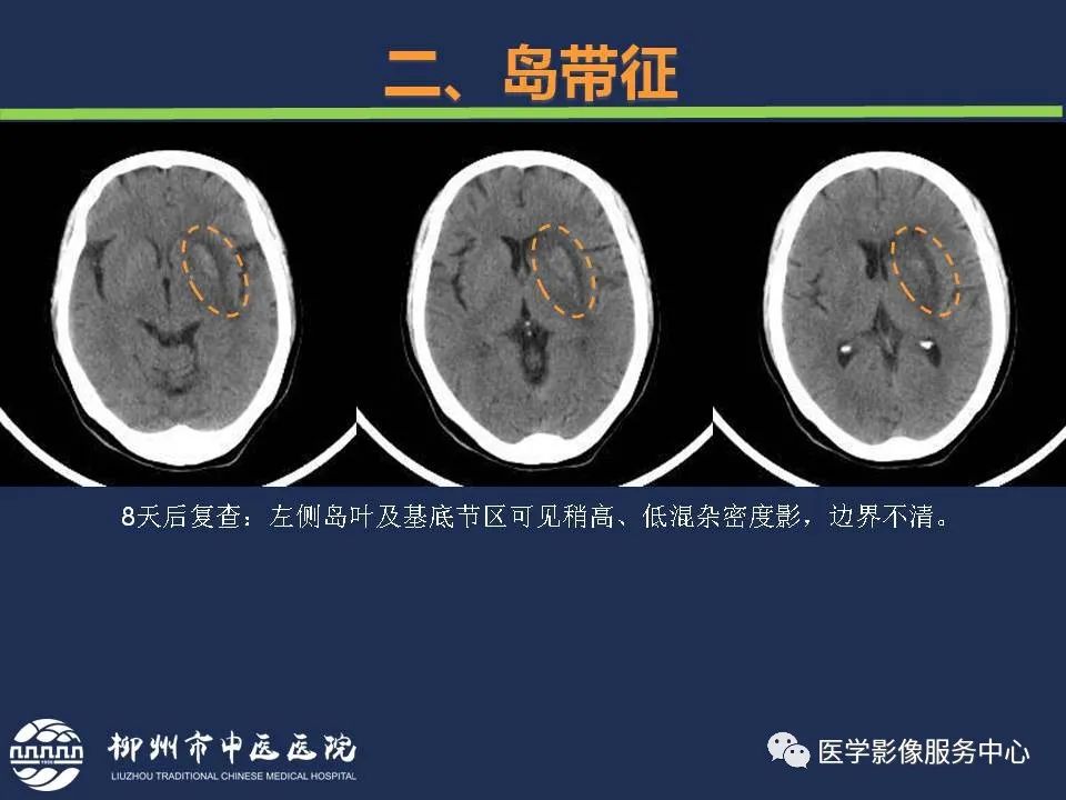 影像PPT - 【PPT】超早期脑梗死CT征象-27