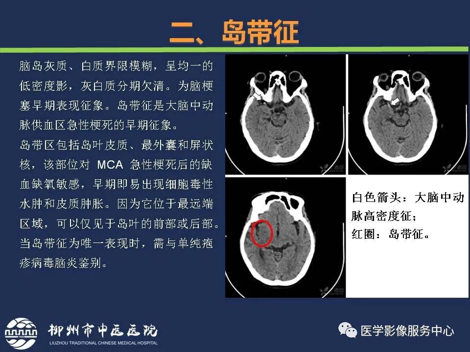 影像PPT - 【PPT】超早期脑梗死CT征象-28