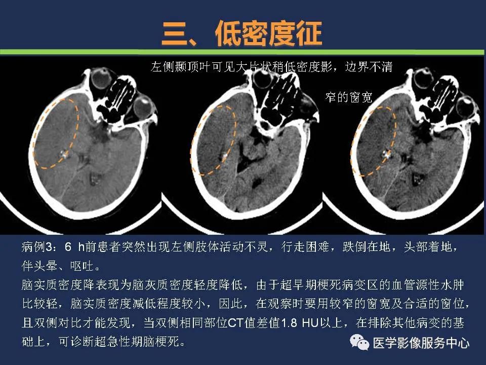 影像PPT - 【PPT】超早期脑梗死CT征象-29